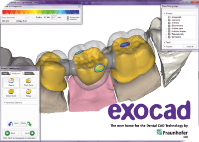 Exocad software dentalCAD